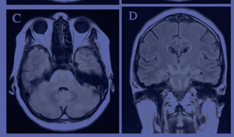 La recherche explore les présentations cliniques de la neuroborréliose de Lyme