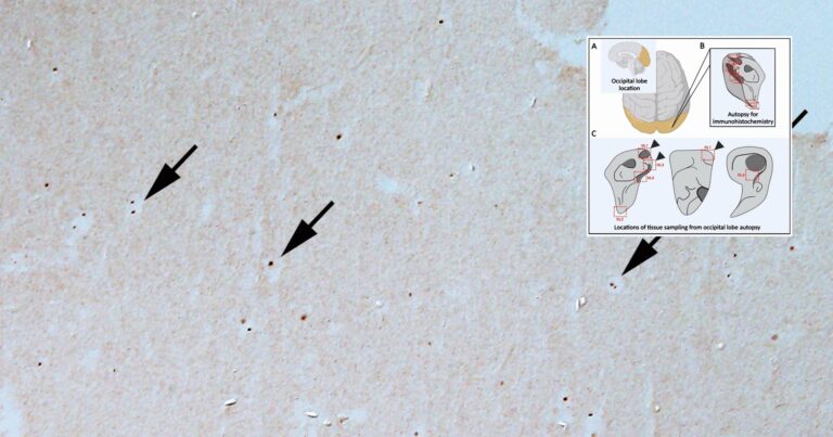 Une figure des emplacements de test de cerveau au-dessus d’une image microscopique de Borrelia.